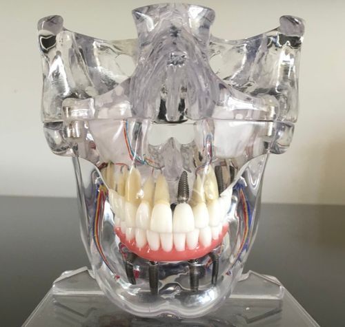 Dental Implant